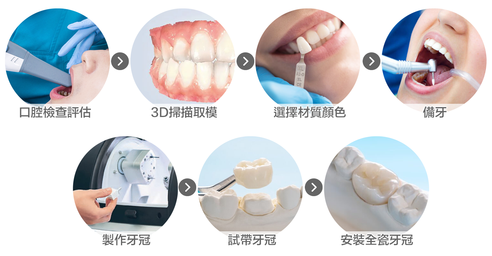 全瓷牙冠 製作過程