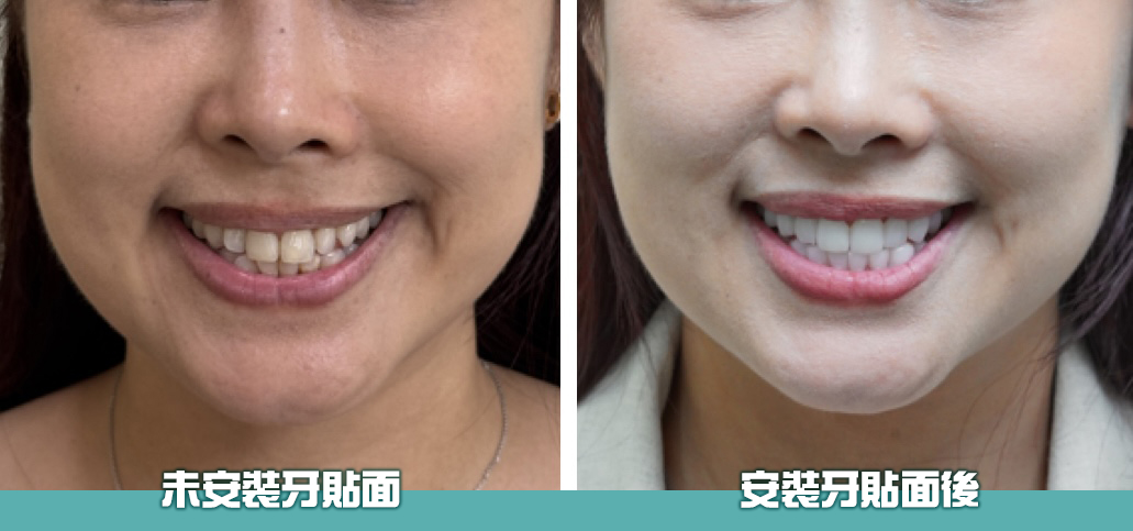 牙貼面效用 牙貼面效用