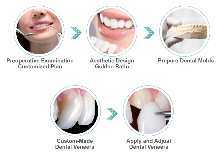  Dental Veneer Production