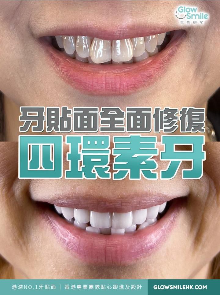 修復蝴蝶牙案例