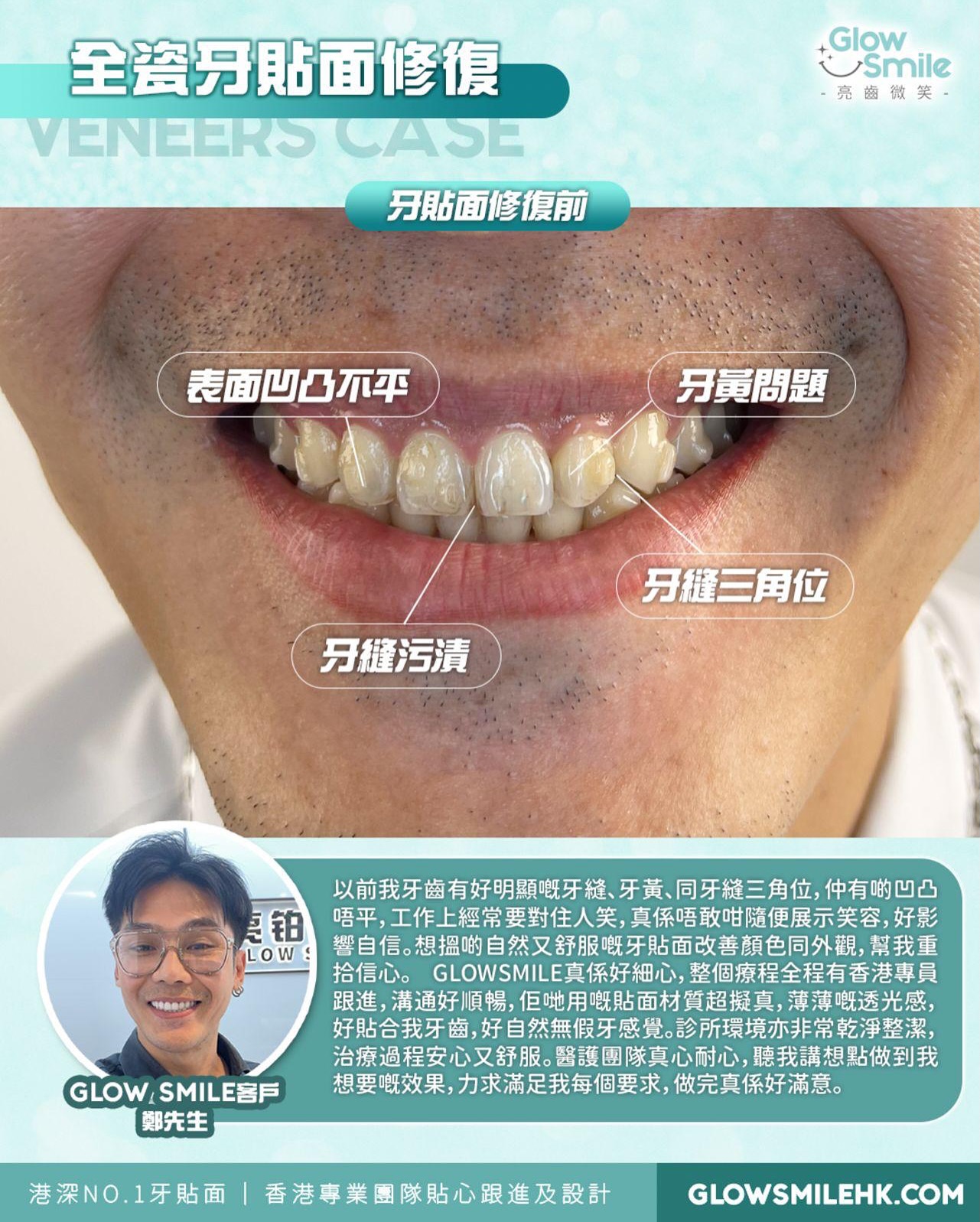 全瓷牙貼面修復 鄭先生