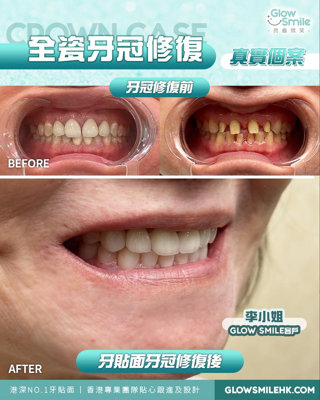 全瓷牙冠真實案例